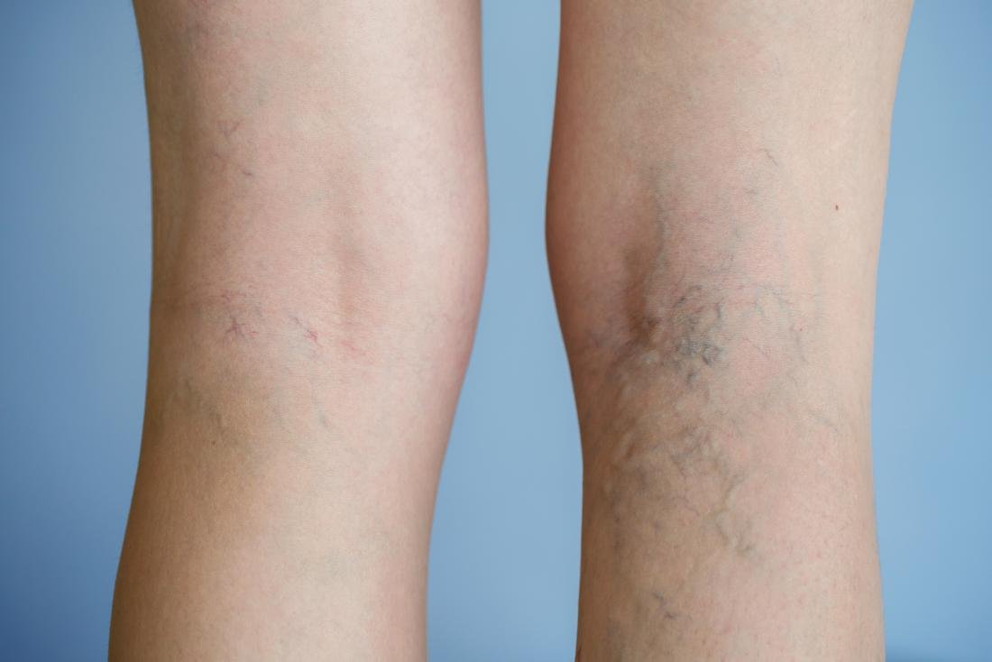 Varicose veins on backs of legs.