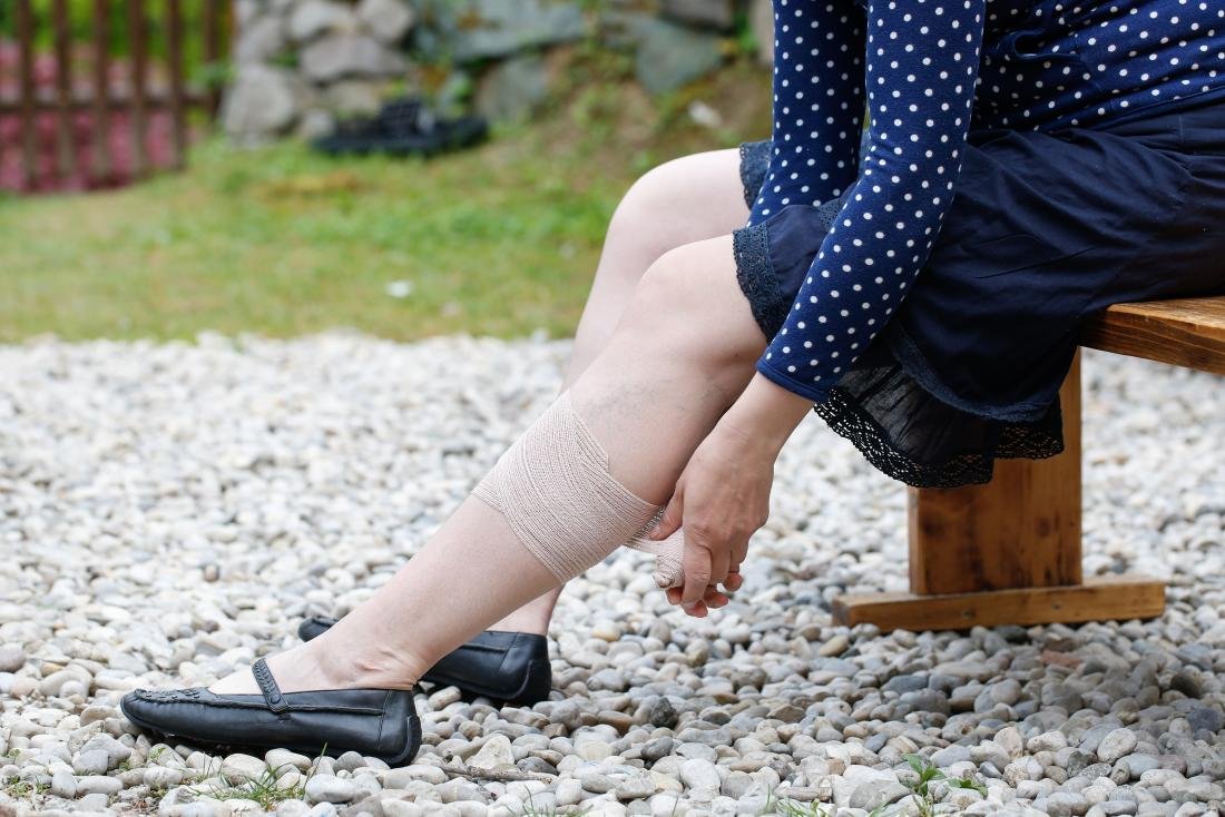 Woman putting compression stocking on to treat varicose veins.